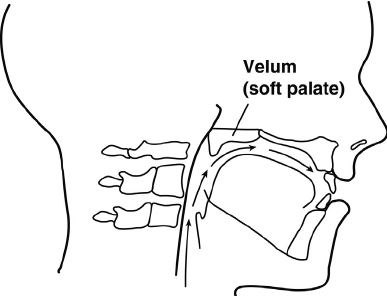 Do you have a palatal leak (aka Velopharyngeal Insufficiency)?